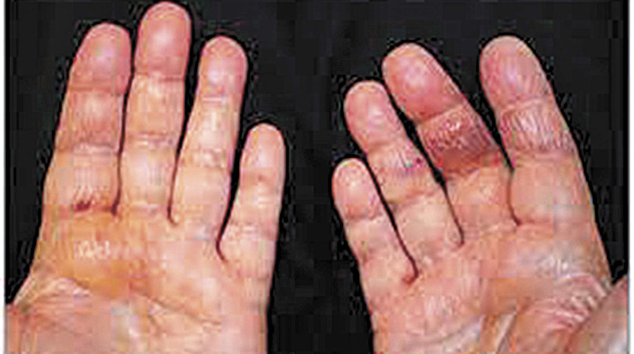 Amiloidosis Hereditaria Afecta A Familias Completas Morelos Presenta 