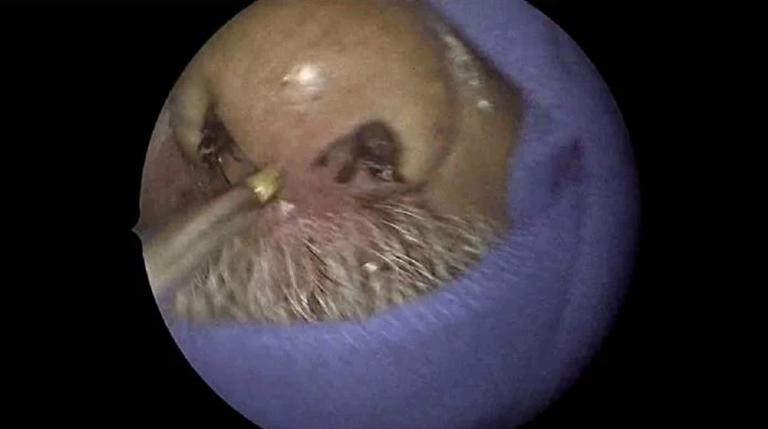 ¡Sorprendente!: Hombre tenía 150 larvas en su nariz sin saberlo  