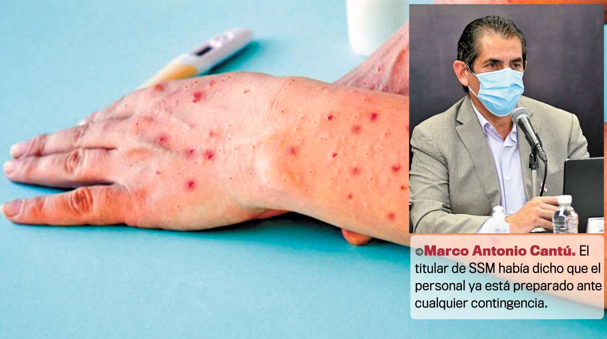 First case of monkeypox reported in Morelos |  News