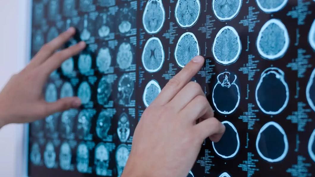 Aprueba FDA nuevo tratamiento para Alzheimer que retarda su avance