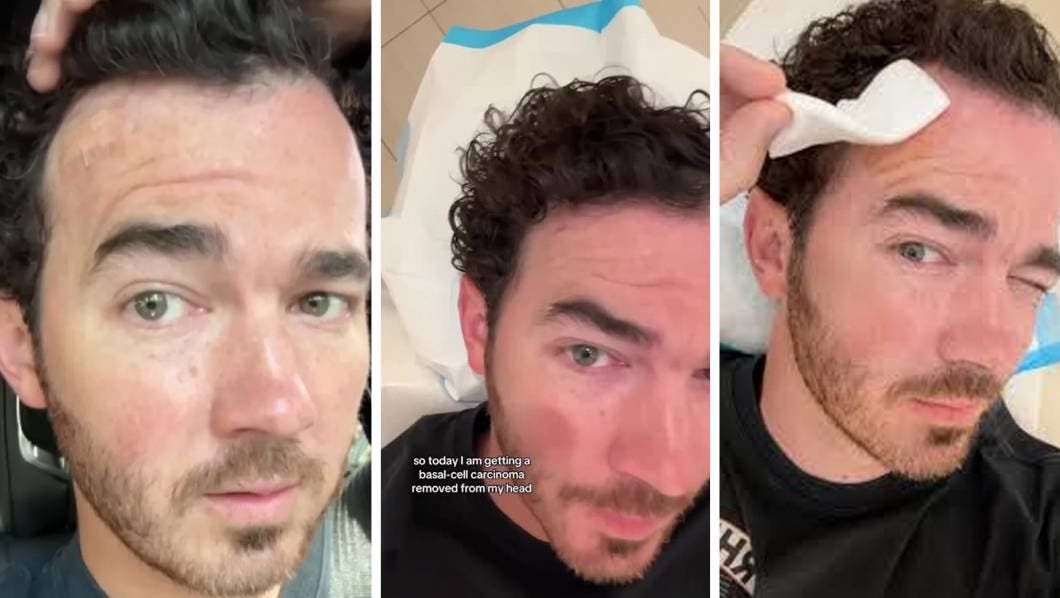 Pon atención a tus lunares: Kevin Jonas se sometió a cirugía para extirpar cáncer de piel