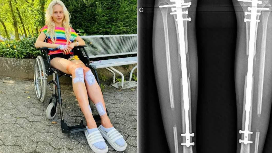 Modelo paga 130 Mil euros por una cirugía para aumentar su estatura