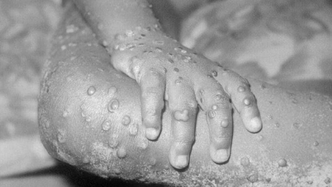 Alertan sobre el aumento de casos de mpox en recién nacidos; Preocupa a la OMS