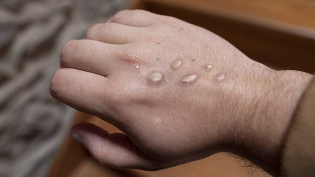 Reportan en Suecia primer caso de cepa mortal de mpox fuera de África