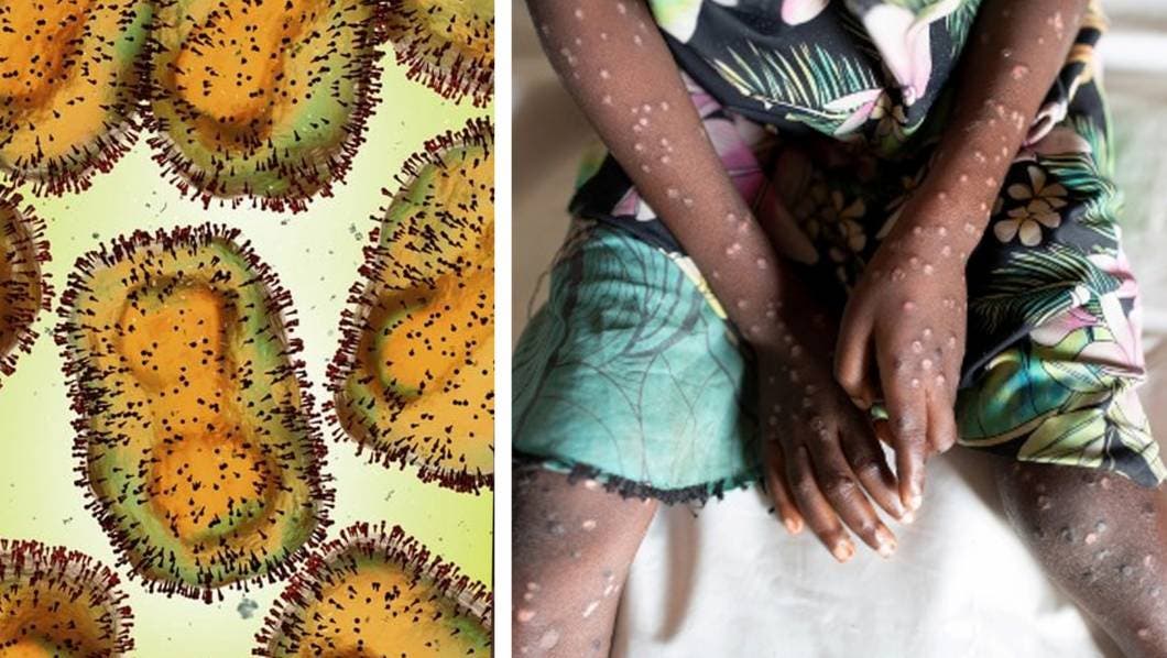 Es oficial: OMS declara el mpox como emergencia internacional de salud pública