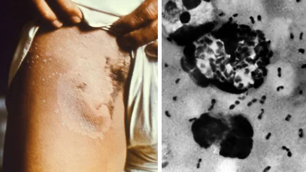 Se confirma tercer caso de peste bubónica en Estados Unidos; Estos son los síntomas 