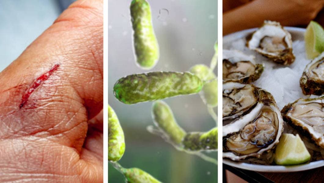 Caso Laura Barajas: ¿Cómo podemos evitar infectarnos de la “bacteria come carne"?