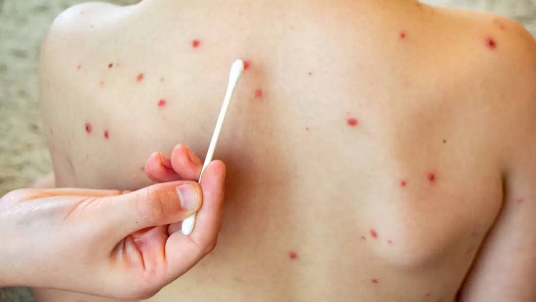 Confirman 3 nuevos casos de sarampión en Jonacatepec