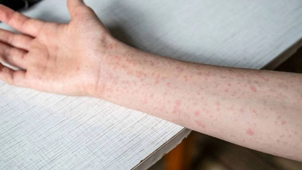 Morelos confirma nuevo caso de sarampión: suman 19 en 2025