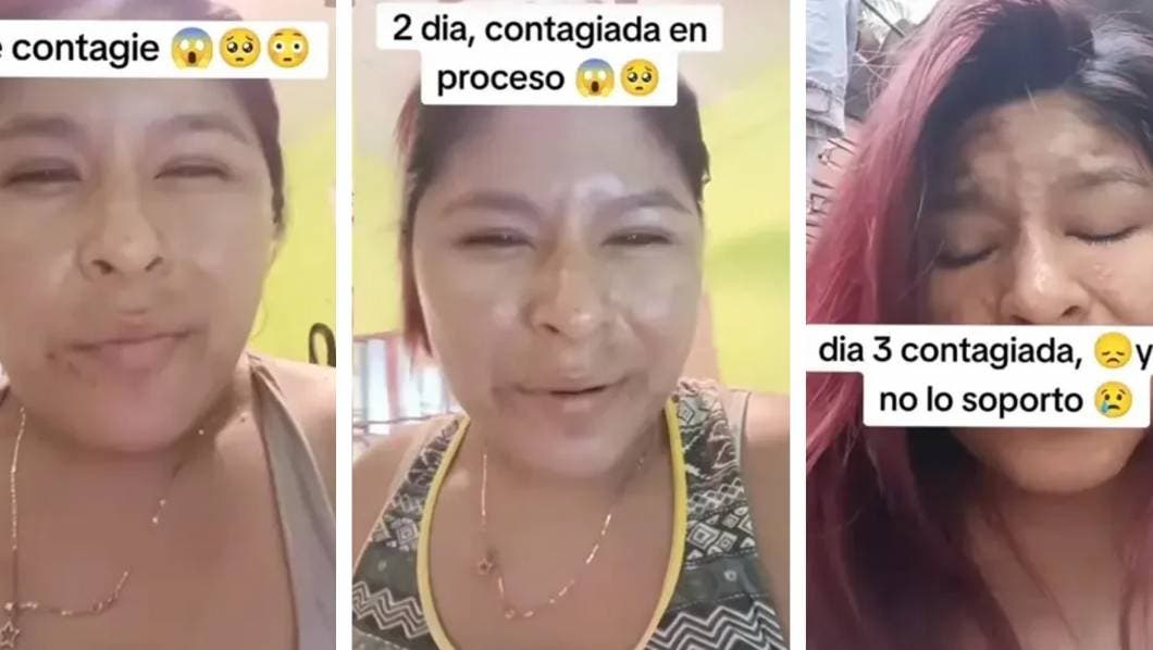 Joven con viruela del mono cuenta su experiencia al contagiarse: “Me doy asco”
