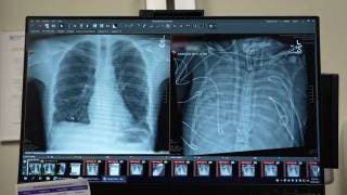 Impresionante caso médico del paciente que sobrevivió 48 horas sin pulmones