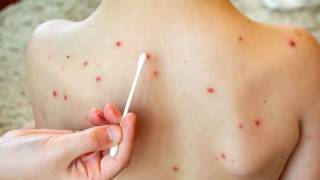 México enfrenta repunte de sarampión: propagación, causas y medidas para evitarlo