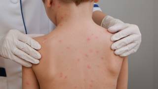 Repunte de sarampión en México deja 27 fallecidos; niños, lo...