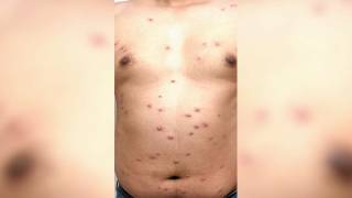 Suman en Morelos ya 3 casos de viruela d 2