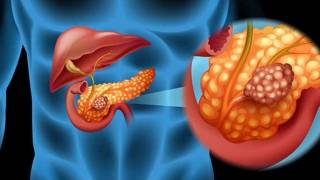 Avance histórico contra el cáncer de páncreas: científicos logran eliminar tumores por com...