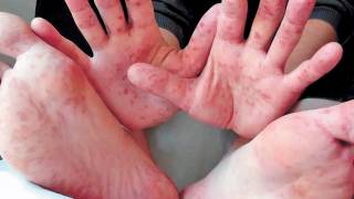 Confirman casos de enfermedad de manos, 2