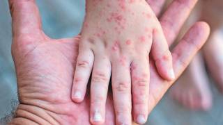 Sarampión es más contagioso que Covid