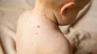 Se registran en un año 24 casos de sarampión
