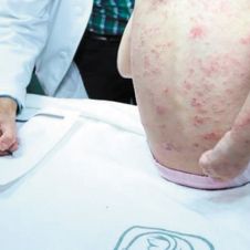 Lepra-IMSS-300119.jpg