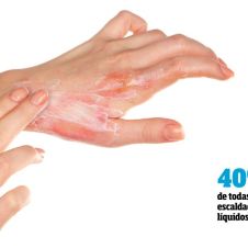 como-tratar-las-quemaduras-leves-200219.jpg