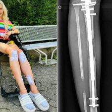 Modelo paga 130 Mil euros por una cirugía para aumentar su estatura