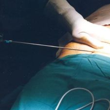 Una liposucción le costó la vida a mujer que buscaba mejorar su cuerpo.jpg