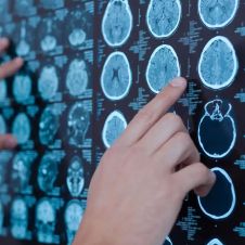 Aprueba FDA nuevo tratamiento para Alzheimer que retarda su avance