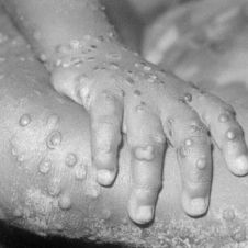 Alertan sobre el aumento de casos de mpox en recién nacidos; Preocupa a la OMS