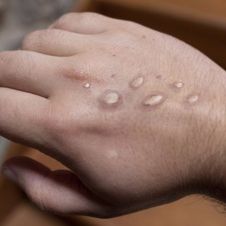 Reportan en Suecia primer caso de cepa mortal de mpox fuera de África