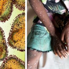 Es oficial: OMS declara el mpox como emergencia internacional de salud pública