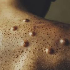 Alerta de la Secretaría de Salud: Incrementan riesgo de mpox para viajeros mexicanos