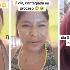 Joven con viruela del mono cuenta su experiencia al contagiarse: “Me doy asco”