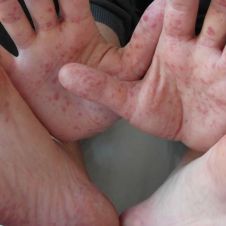 virus coxsackie cuautla ok.jpg