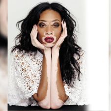 vitiligo121219.jpg