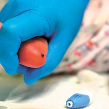 Tamiz Auditivo Neonatal 