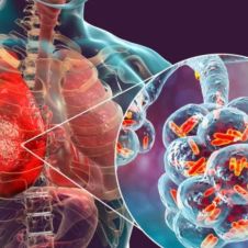 tuberculosis