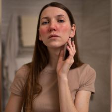 El 90% de los casos de lupus en México ocurren en mujeres jóvenes El 90% de los casos de lupus en México ocurren en mujeres jóvenes