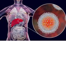 Hepatitis C