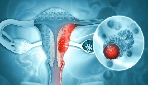 Cáncer de ovario: cómo las trompas de Falopio influyen en el riesgo