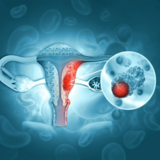 Cáncer de ovario: cómo las trompas de Falopio influyen en el riesgo