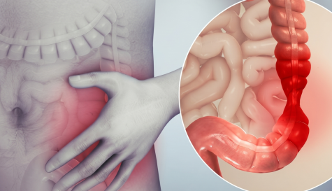 Síndrome de Intestino Irritable: Síntomas y su Impacto Real