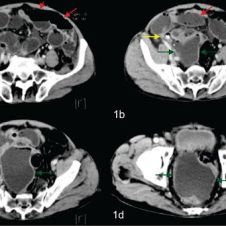 tomografia apendicitis.jpg