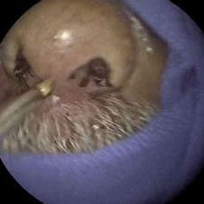 ¡Sorprendente!: Hombre tenía 150 larvas en su nariz sin saberlo  