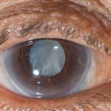 ojos-con-cataratas.jpg